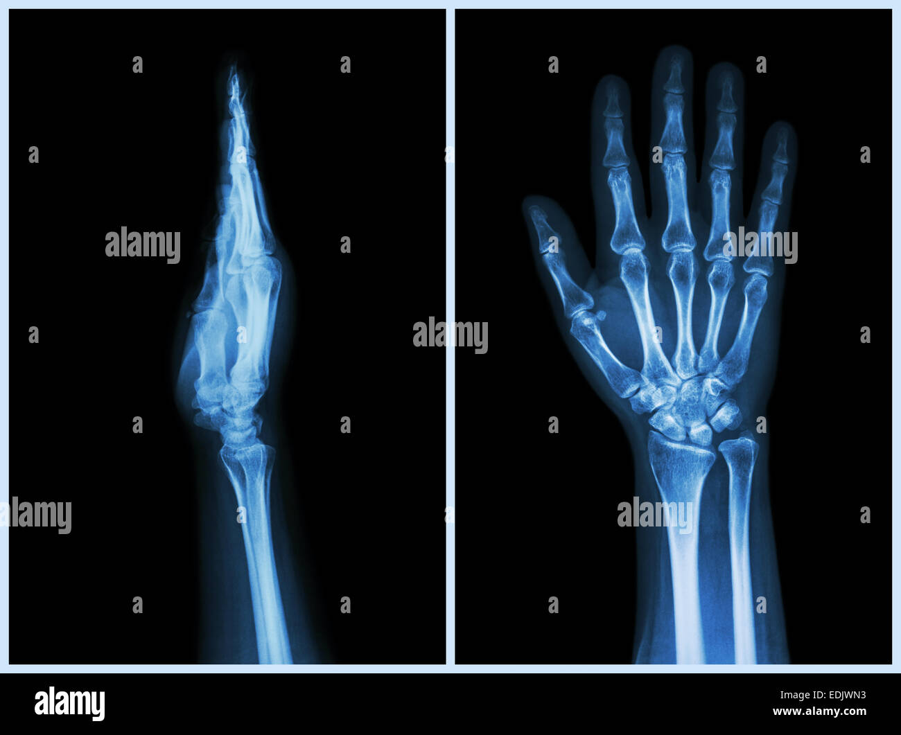 XRay Mains et avant ( ) Vue du côté des mains humaines normales Photo Stock Alamy