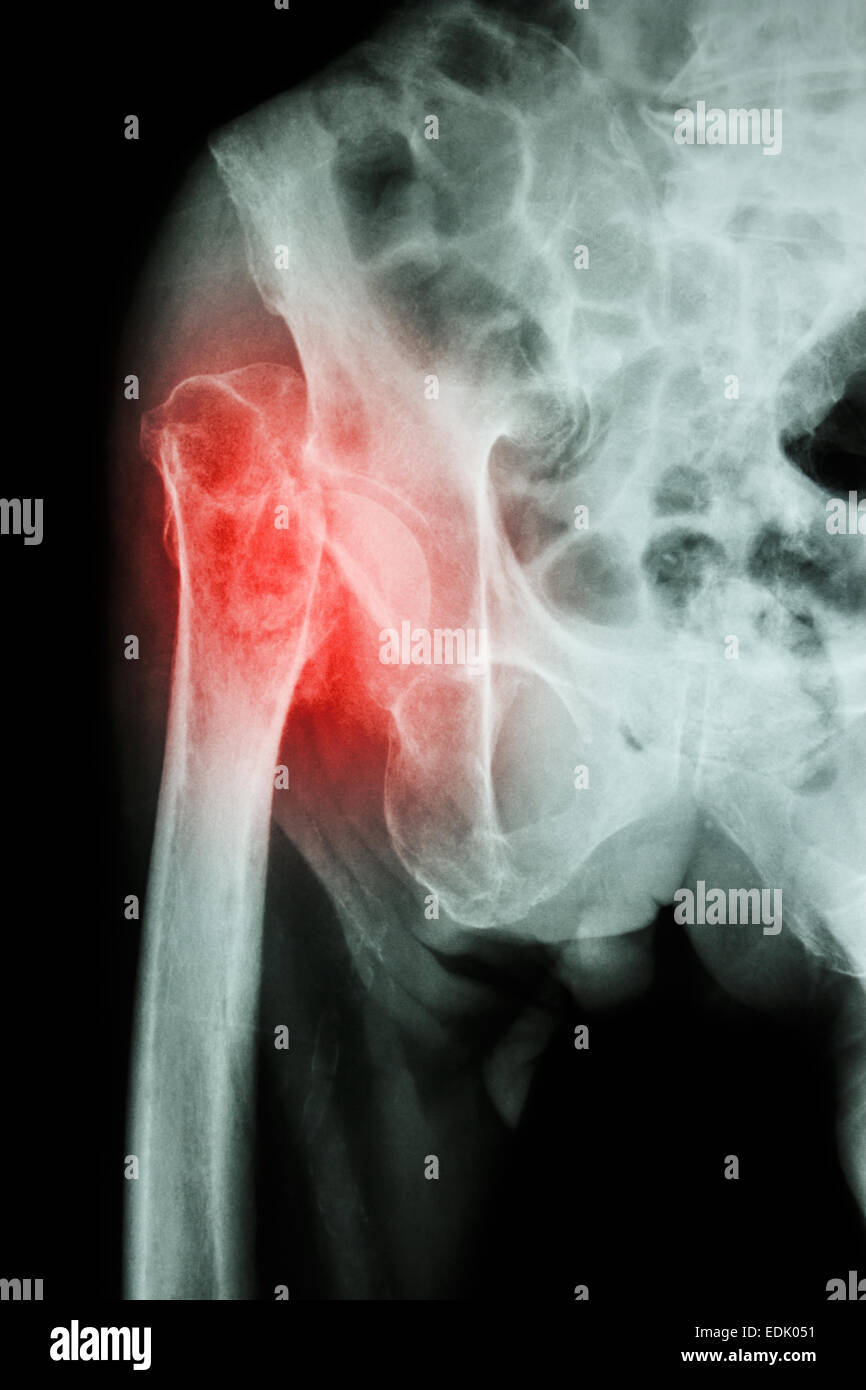 X-ray & pelvis hanche Fracture : tête du fémur (os de la cuisse) Banque D'Images