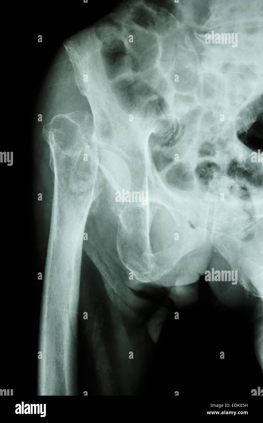 X-ray & pelvis hanche Fracture : tête du fémur (os de la cuisse) Banque D'Images