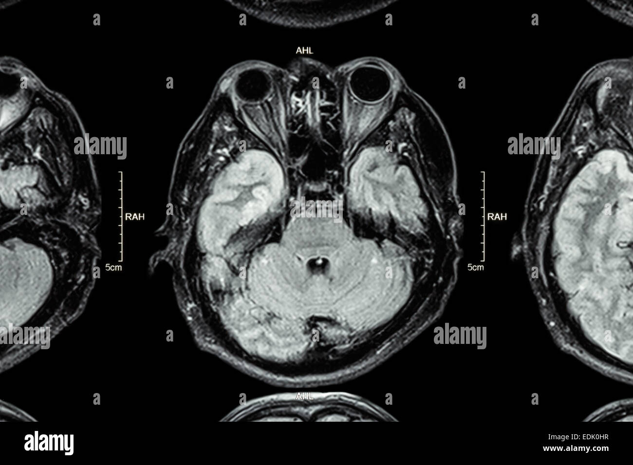 Close up de l'IRM cerveau : partie inférieure du cerveau (lobe temporal , les yeux du cerveau , , cervelet tronc cérébral ) Banque D'Images