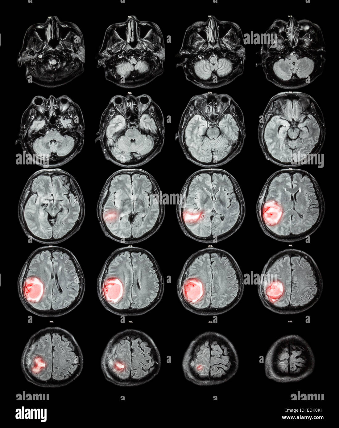 Cerveau IRM : tumeur au cerveau au lobe pariétal droit Banque D'Images