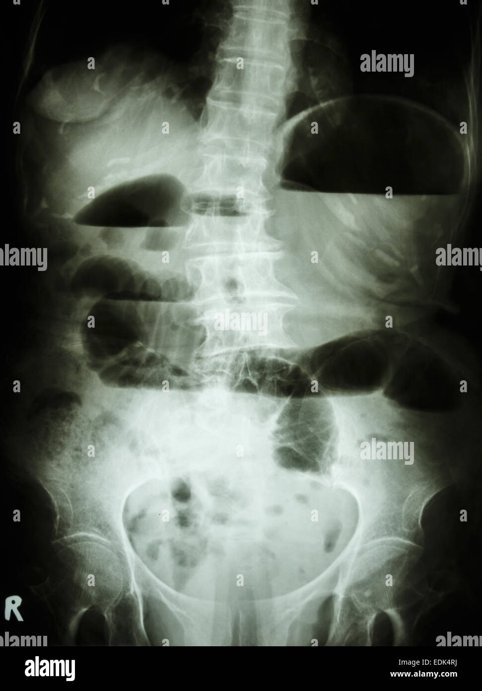Film X-ray abdomen show debout petit intestin dilaté et de niveau de liquide dans l'intestin grêle occlusion intestinale due à la petite Banque D'Images