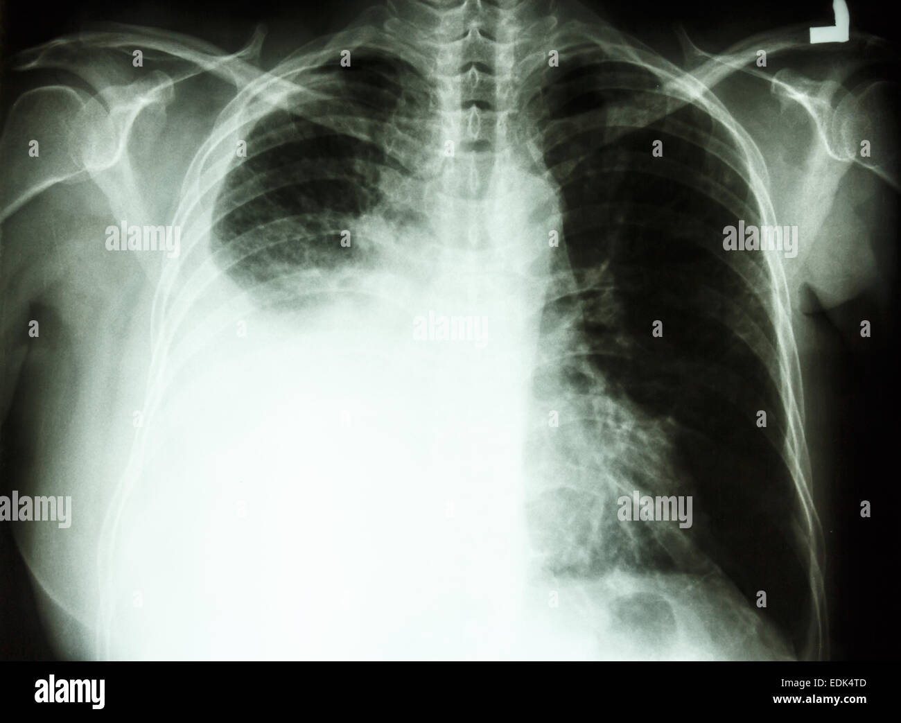 Film radiographie de la PA en position verticale : spectacle d'épanchement pleural au poumon droit due au cancer du poumon Banque D'Images