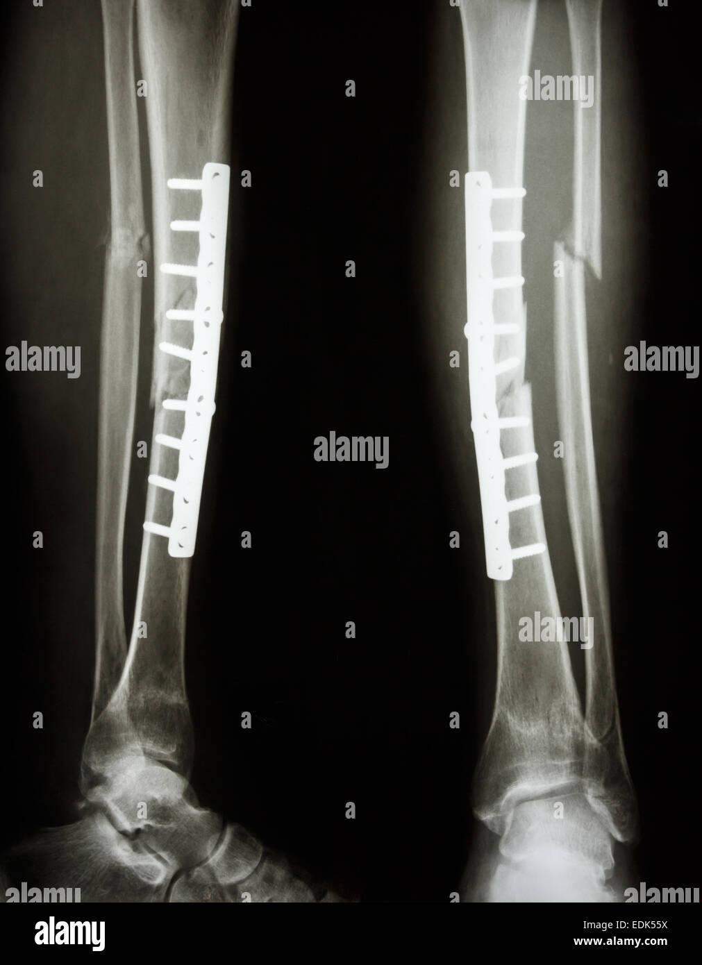 AP/latérale de la jambe du film : montrer l'arbre d'une fracture du tibia et du péroné (os de la jambe). patient a été opéré et insérer la plaque et vis pour Banque D'Images