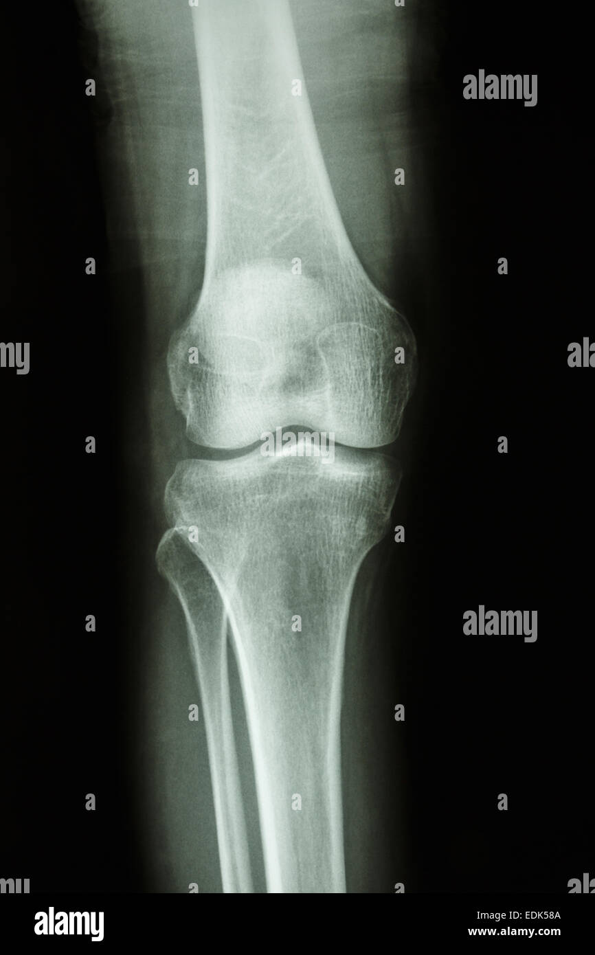 Flim X-ray genou AP : montrer l'articulation du genou humain normal Banque D'Images