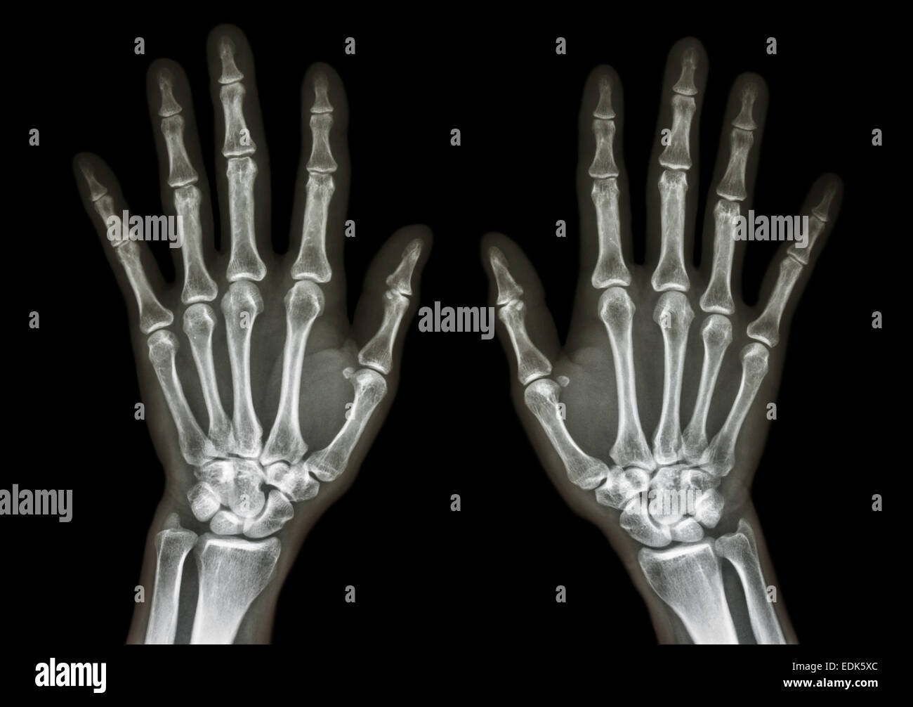Film x-ray mains deux AP : montrer les mains humaines normales sur fond noir (isolé) Banque D'Images