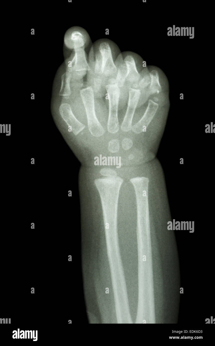 Film x-ray avant-bras et la main : show nourrisson normal's bone Banque D'Images