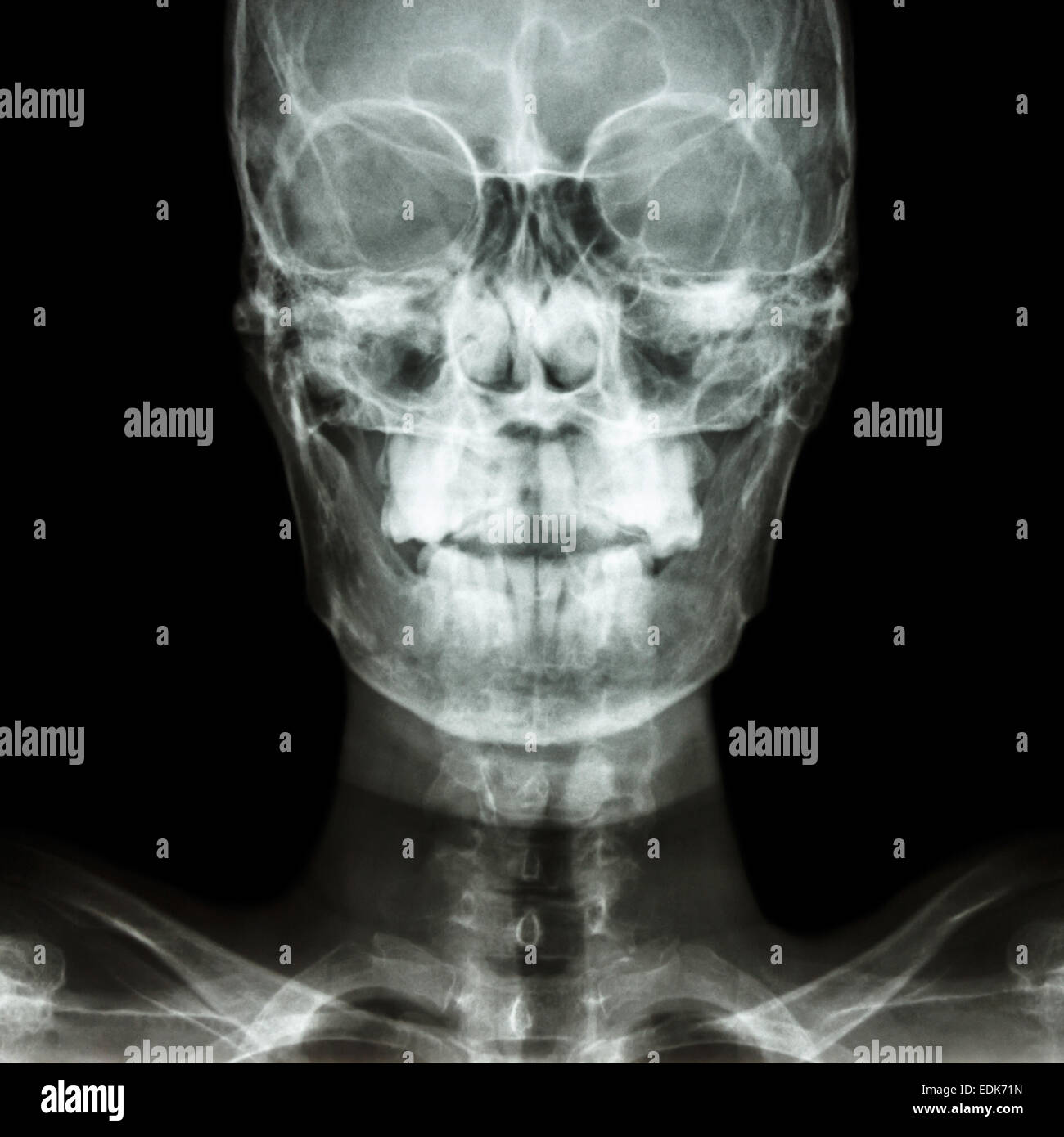 Film x-ray crâne AP : montrer le crâne humain normal et la zone vide du côté droit Banque D'Images