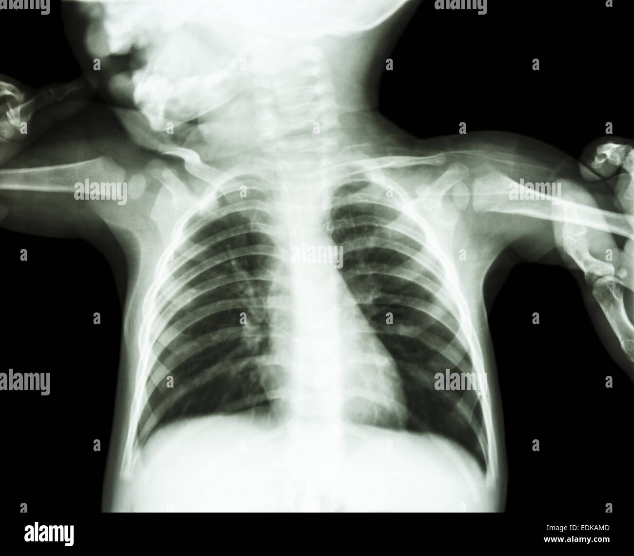 Film x-ray show corps d'enfant et adulte est maintenant aux deux bras de l'enfant Banque D'Images