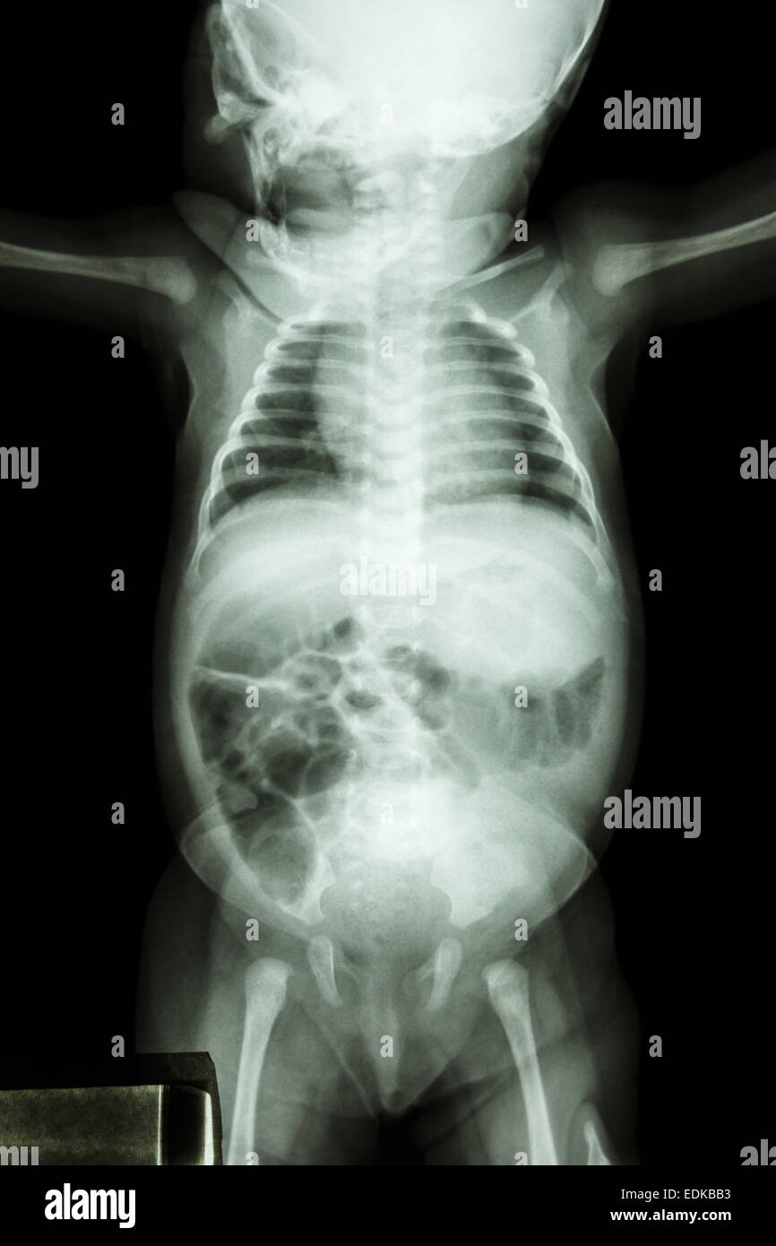 Film x-ray ensemble corps du bébé : corps du bébé normal Banque D'Images