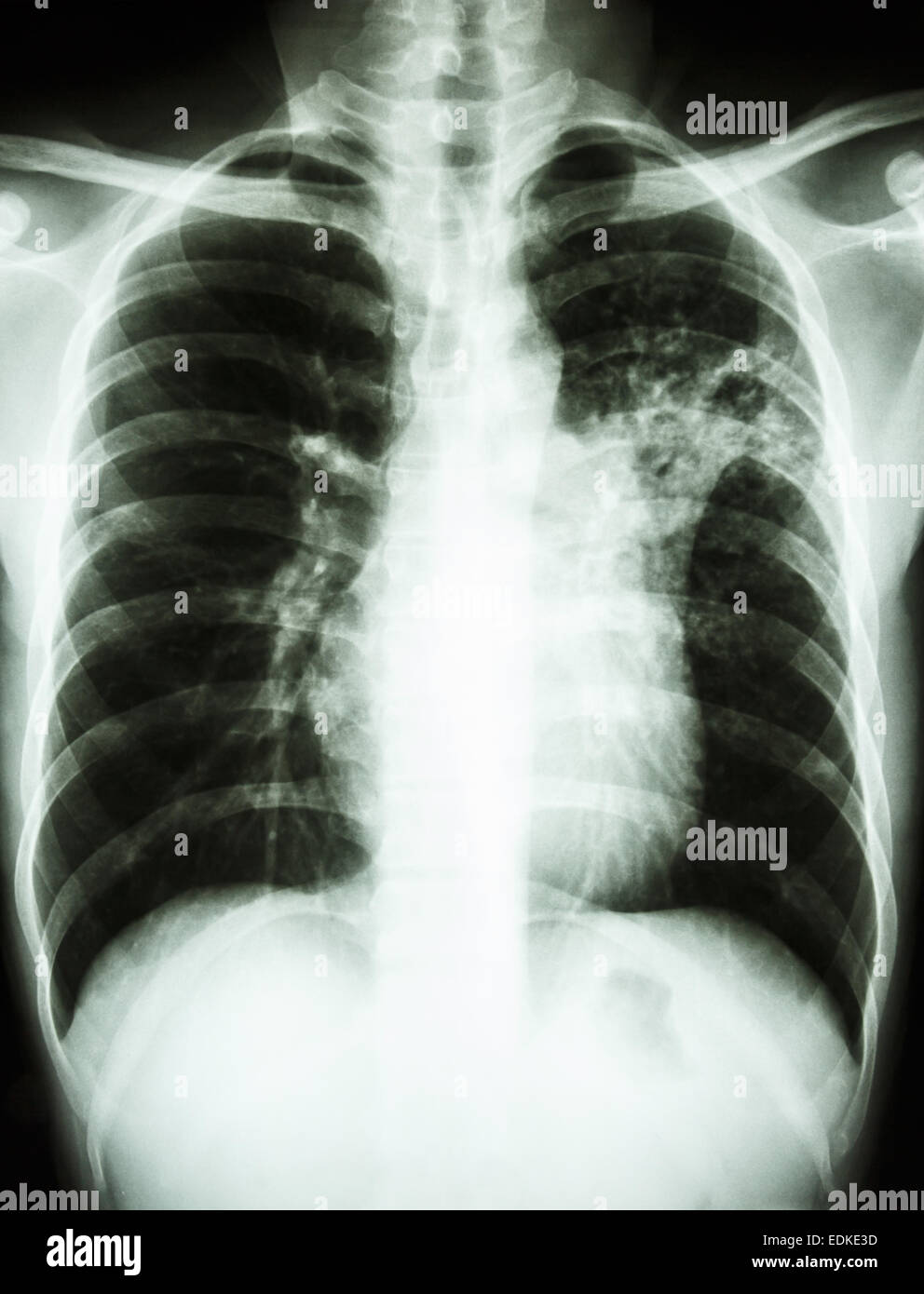 Film radiographie de la montrer à infiltrer alvéolaire pulmonaire moyen gauche en raison de l'infection à Mycobacterium tuberculosis (Tuberculosi pulmonaire Banque D'Images