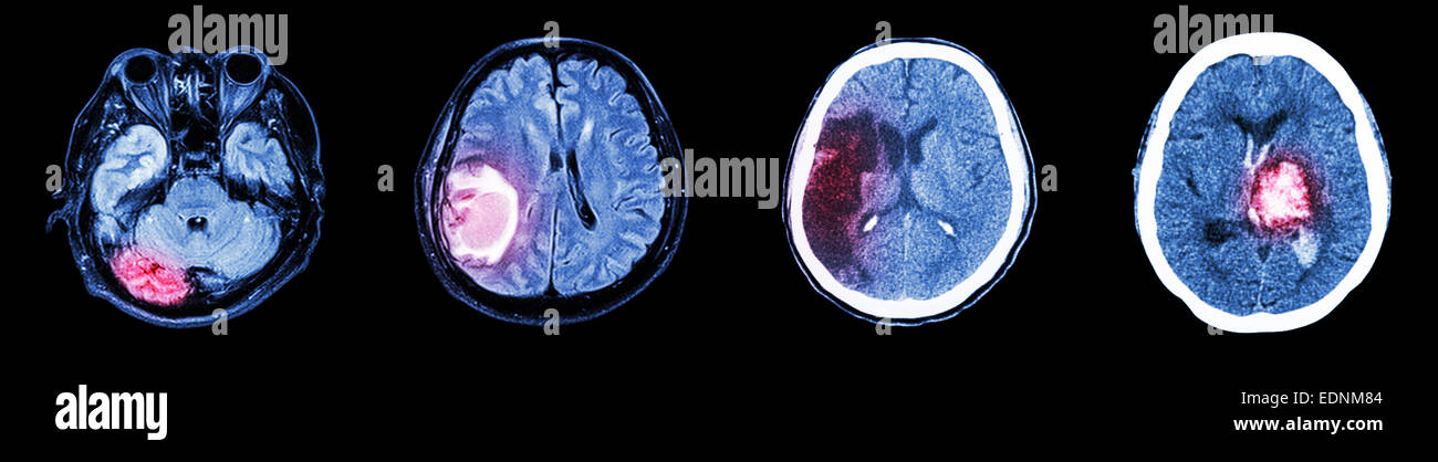 Collection de CT scan et cerveau maladie multiples (de gauche à droite : le fonctionnement normal du cerveau, tumeur au cerveau, l'infarctus cérébral,h intracérébrale Banque D'Images