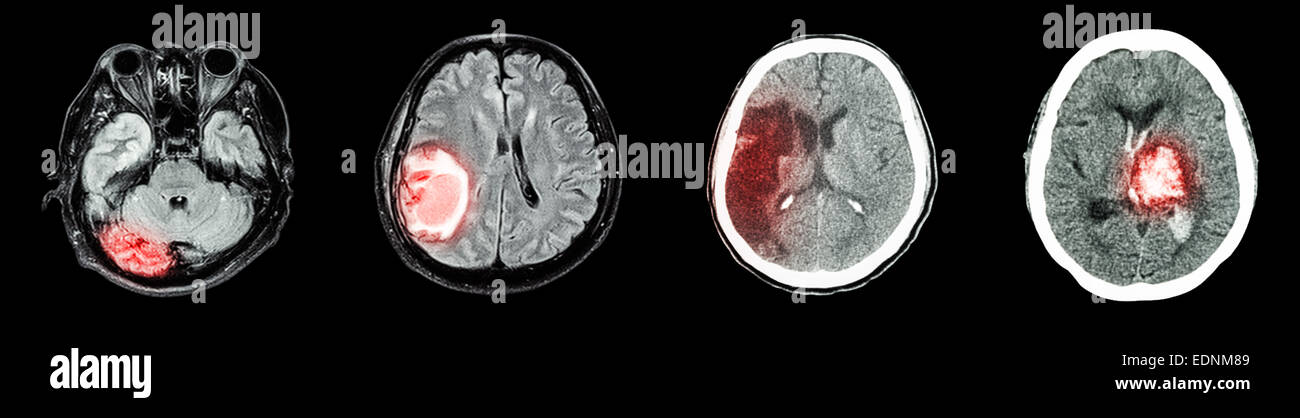 Collection de CT scan et cerveau maladie multiples (de gauche à droite : le fonctionnement normal du cerveau, tumeur au cerveau, l'infarctus cérébral,h intracérébrale Banque D'Images