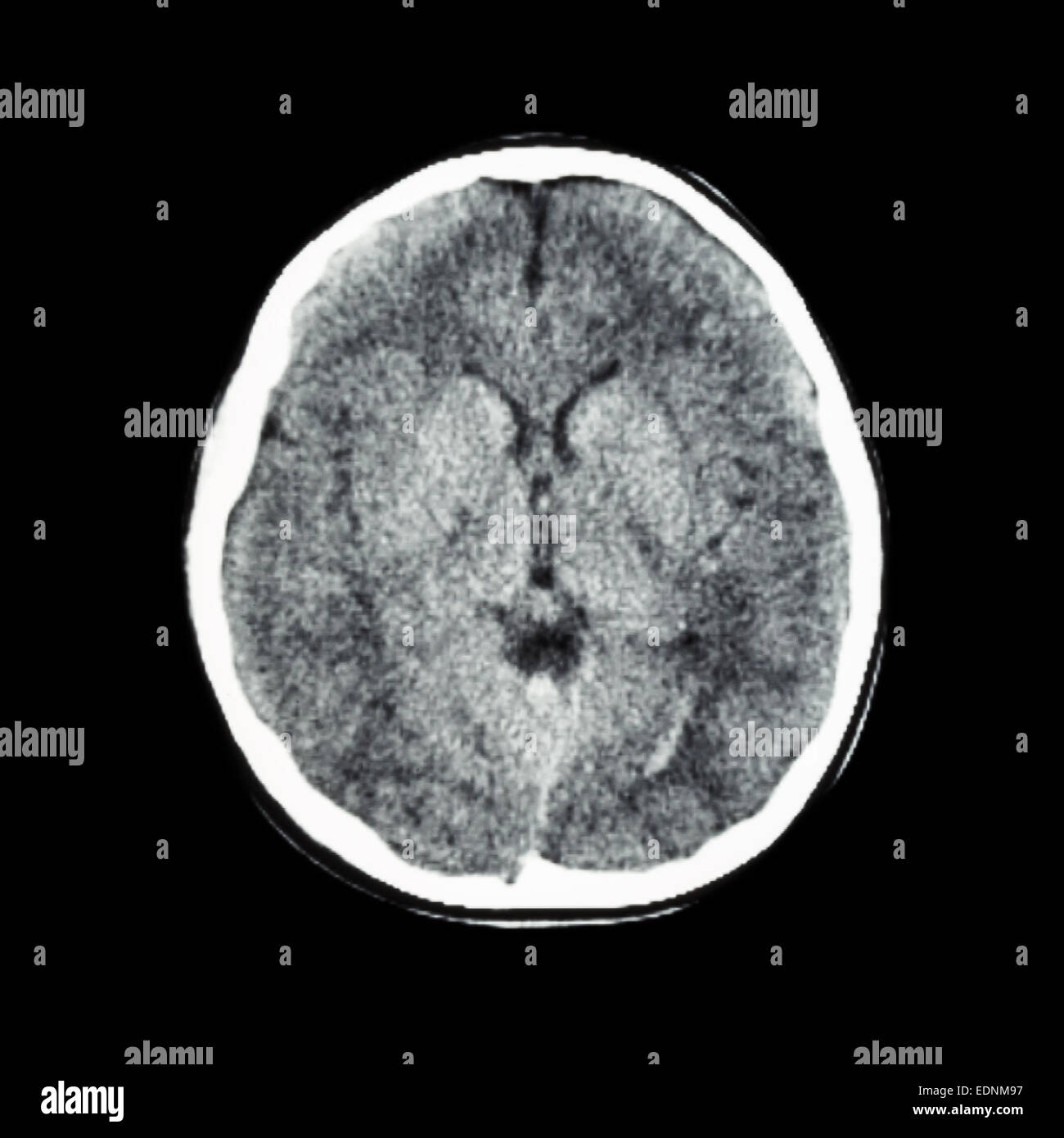 CT scan normal de cerveau (Computed tomography) Banque D'Images