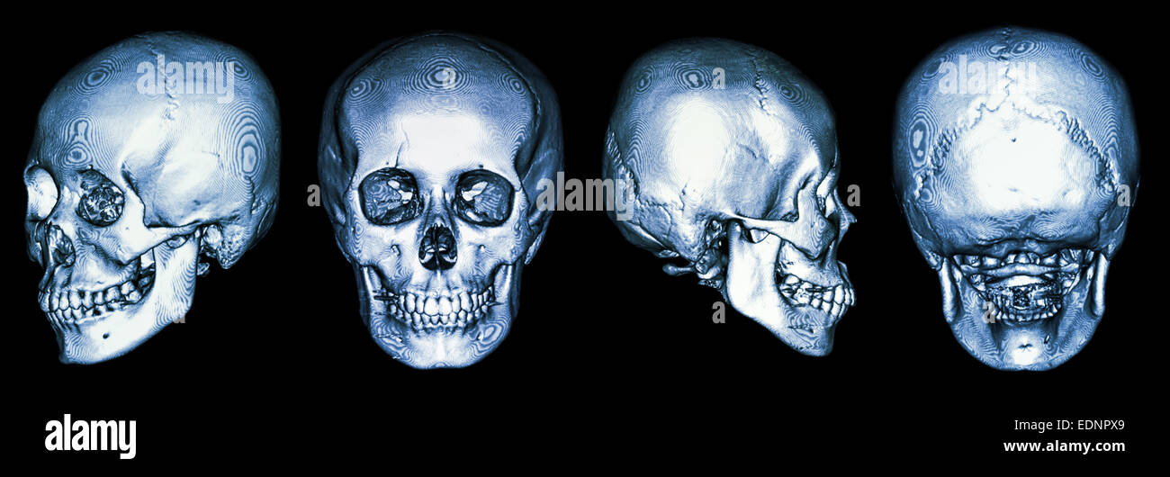 CT scan du crâne humain et 3D Banque D'Images
