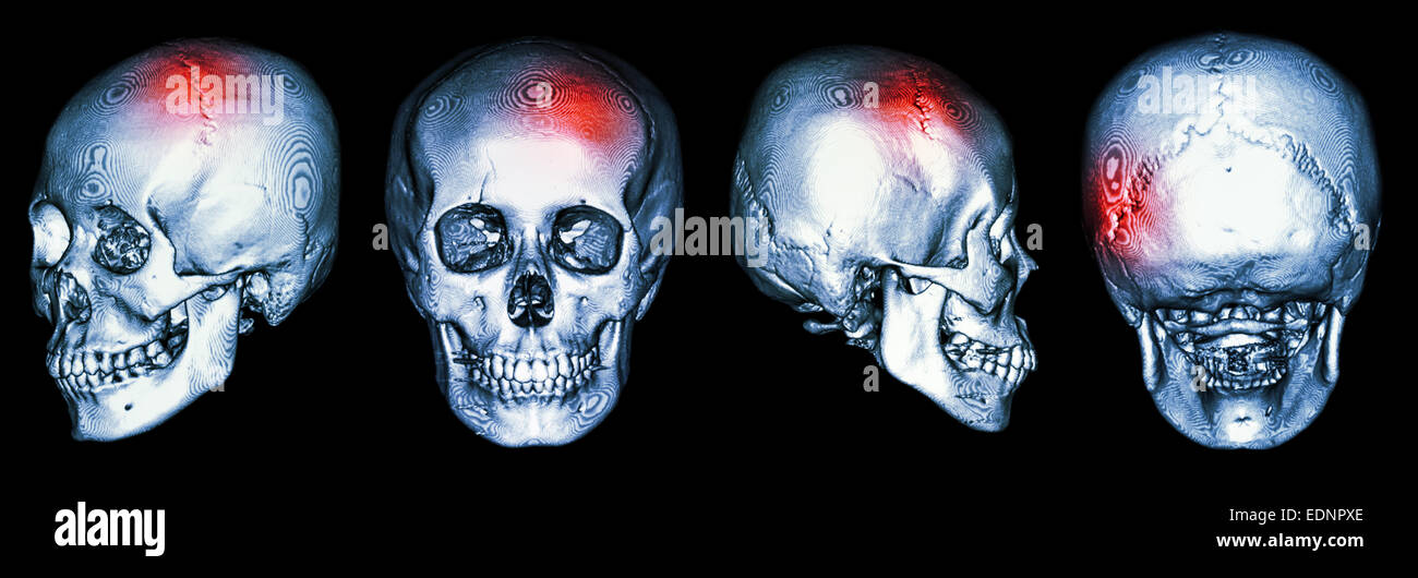 CT scan du crâne humain et 3D avec AVC (accident vasculaire cérébral) Banque D'Images