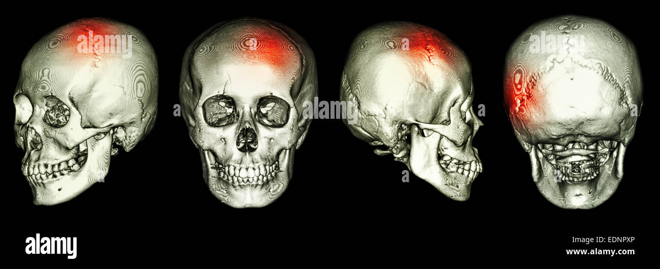CT scan du crâne humain et 3D avec AVC (accident vasculaire cérébral) Banque D'Images