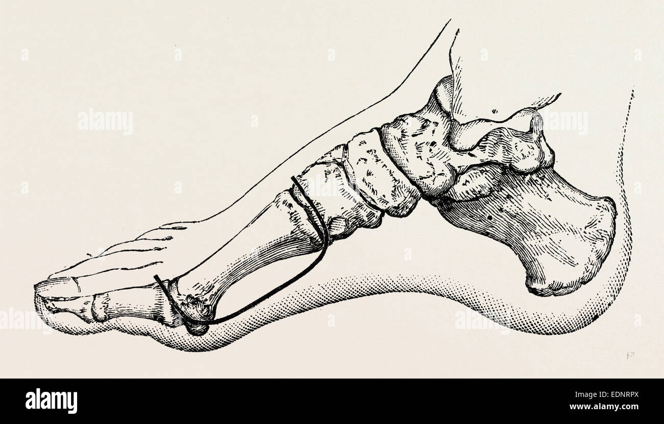 Eicision de premier os métatarsien, rabat, équipement médical, instrument de chirurgie, l'histoire de la médecine Banque D'Images