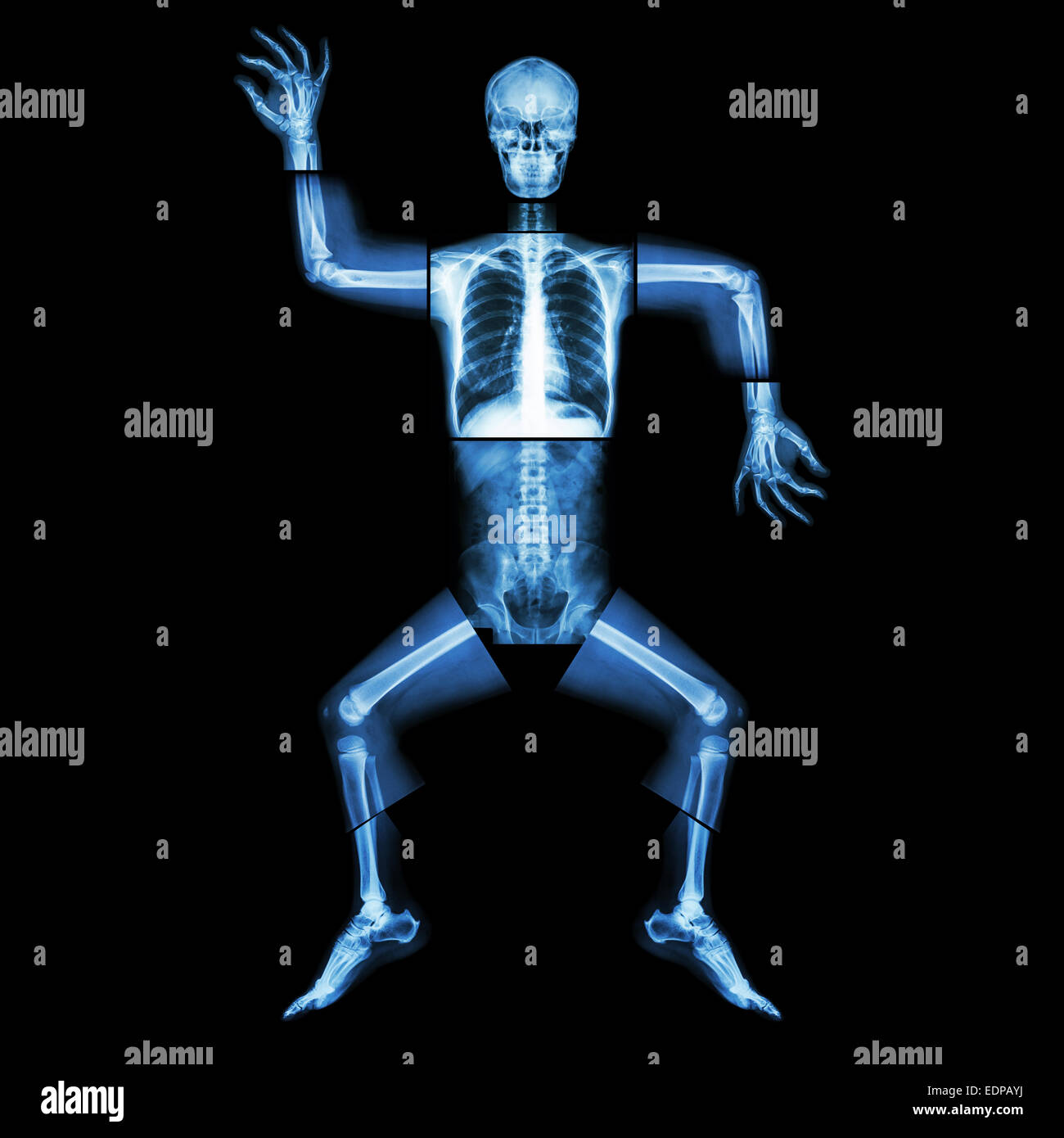 La danse aérobie(os humains est la danse),(corps entier x-ray : tête, cou, thorax, bras, épaule, coude, avant-bras, main, doigt joint , Banque D'Images