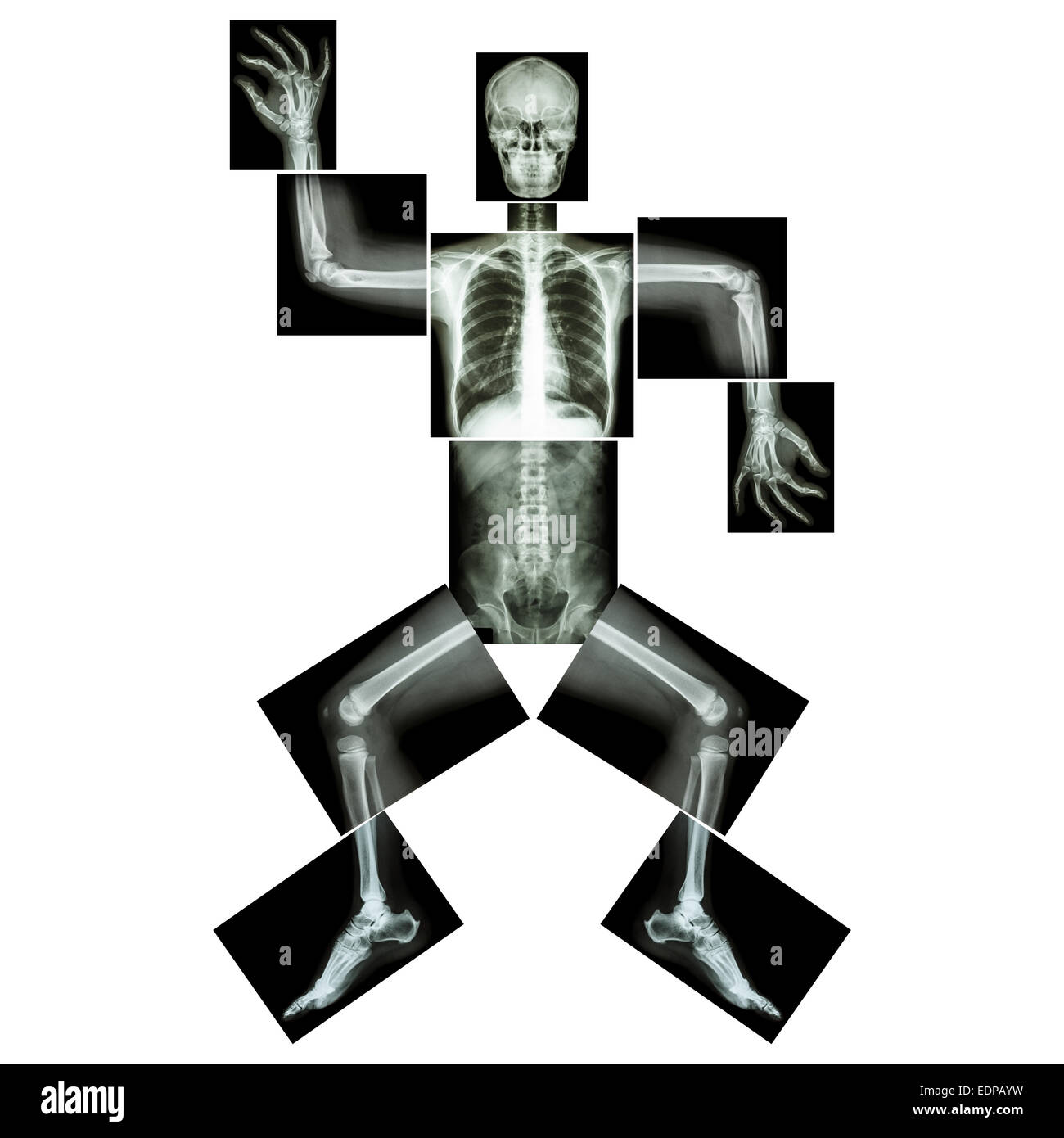La danse aérobie(os humains est la danse),(corps entier x-ray : tête, cou, thorax, bras, épaule, coude, avant-bras, main, doigt joint , Banque D'Images