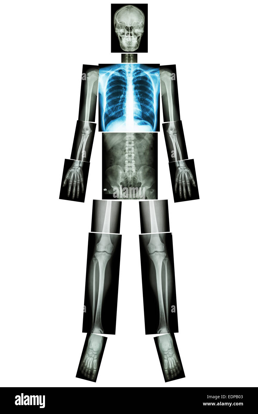 En santé pulmonaire (X-ray corps entier : skull head cou épaule dos thorax cœur pulmonaire poumon poitrine bras avant-bras Coude poignet côtes ha Banque D'Images