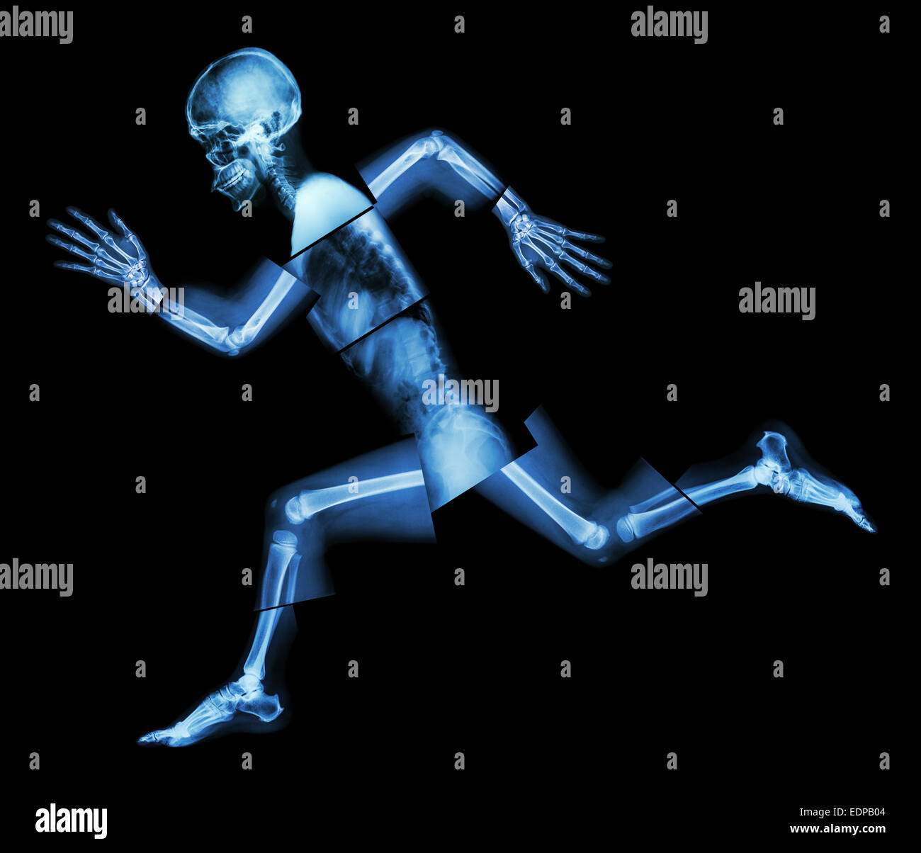 Marathon (les droits de l'os est en marche) ,(corps entier x-ray : tête, cou, bras, épaule, coude, avant-bras, main, doigt ,,commune thorax ,ab Banque D'Images