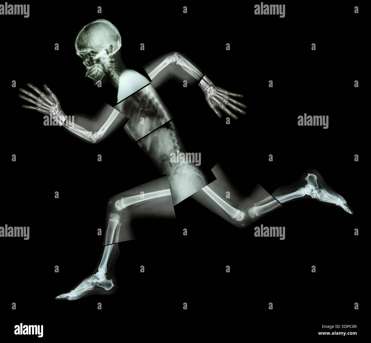 Marathon (les droits de l'os est en marche) ,(corps entier x-ray : tête, cou, bras, épaule, coude, avant-bras, main, doigt ,,commune thorax ,ab Banque D'Images