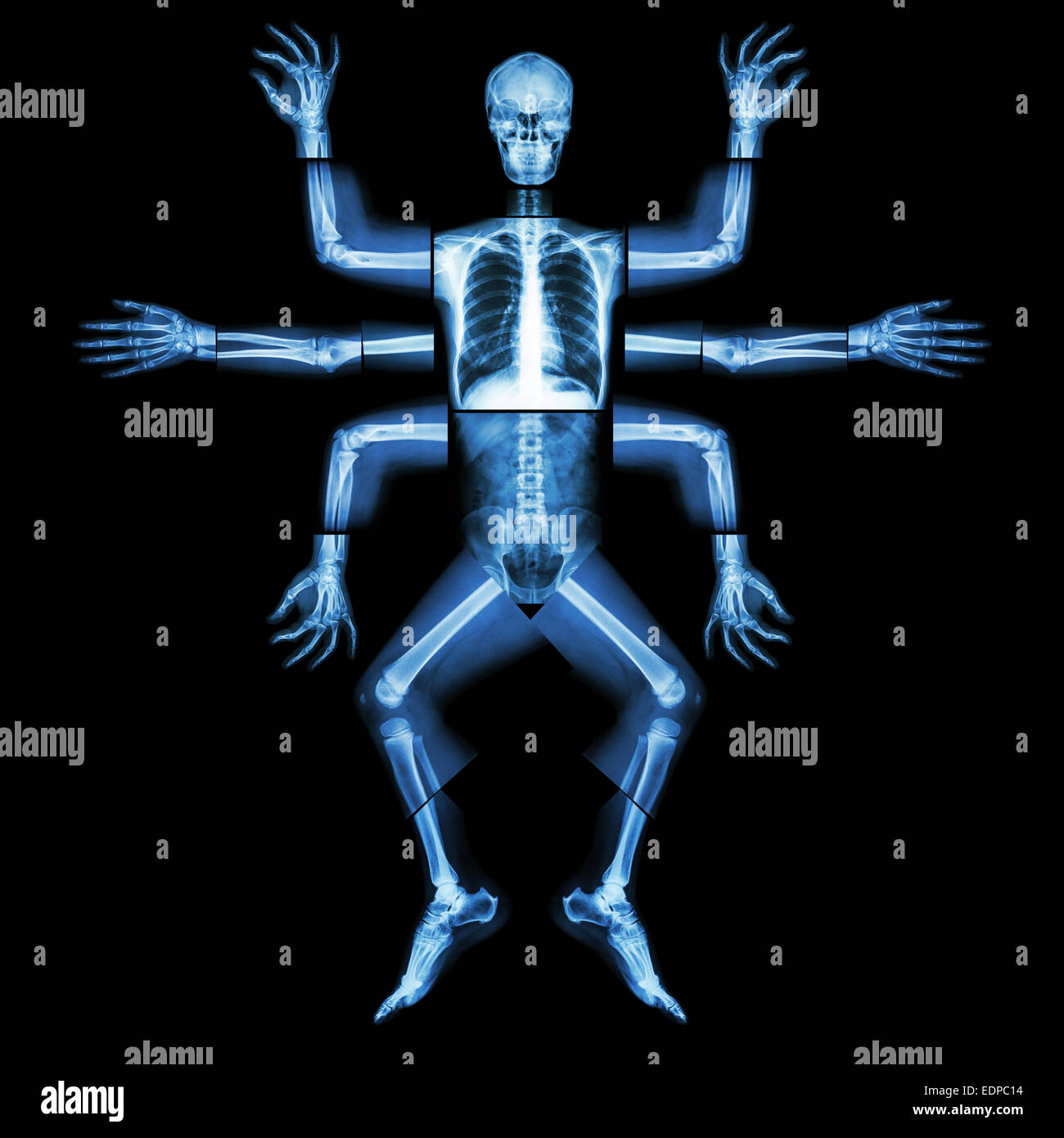 Monster ont de nombreux bras. (X-ray ensemble du corps : la tête cou épaule coude poignet du bras avant-bras main chiffres thorax rachis thoracique cœur pulmonaire abd Banque D'Images