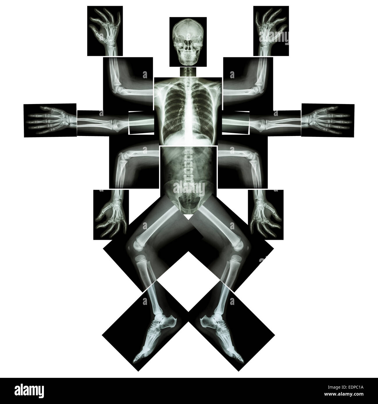 Monster ont de nombreux bras. (X-ray ensemble du corps : la tête cou épaule coude poignet du bras avant-bras main chiffres thorax rachis thoracique cœur pulmonaire abd Banque D'Images