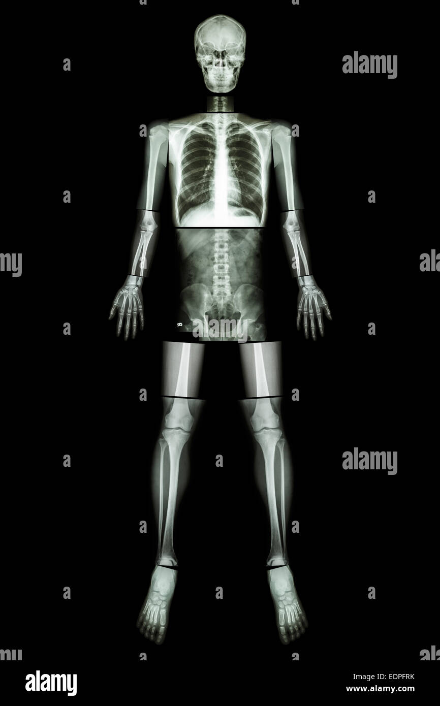 Position anatomique. (X-ray ensemble du corps : tête, cou, thorax, coeur, poumons, côtes, épaule, bras, avant-bras, omoplate coude, poignet ,ha , Banque D'Images