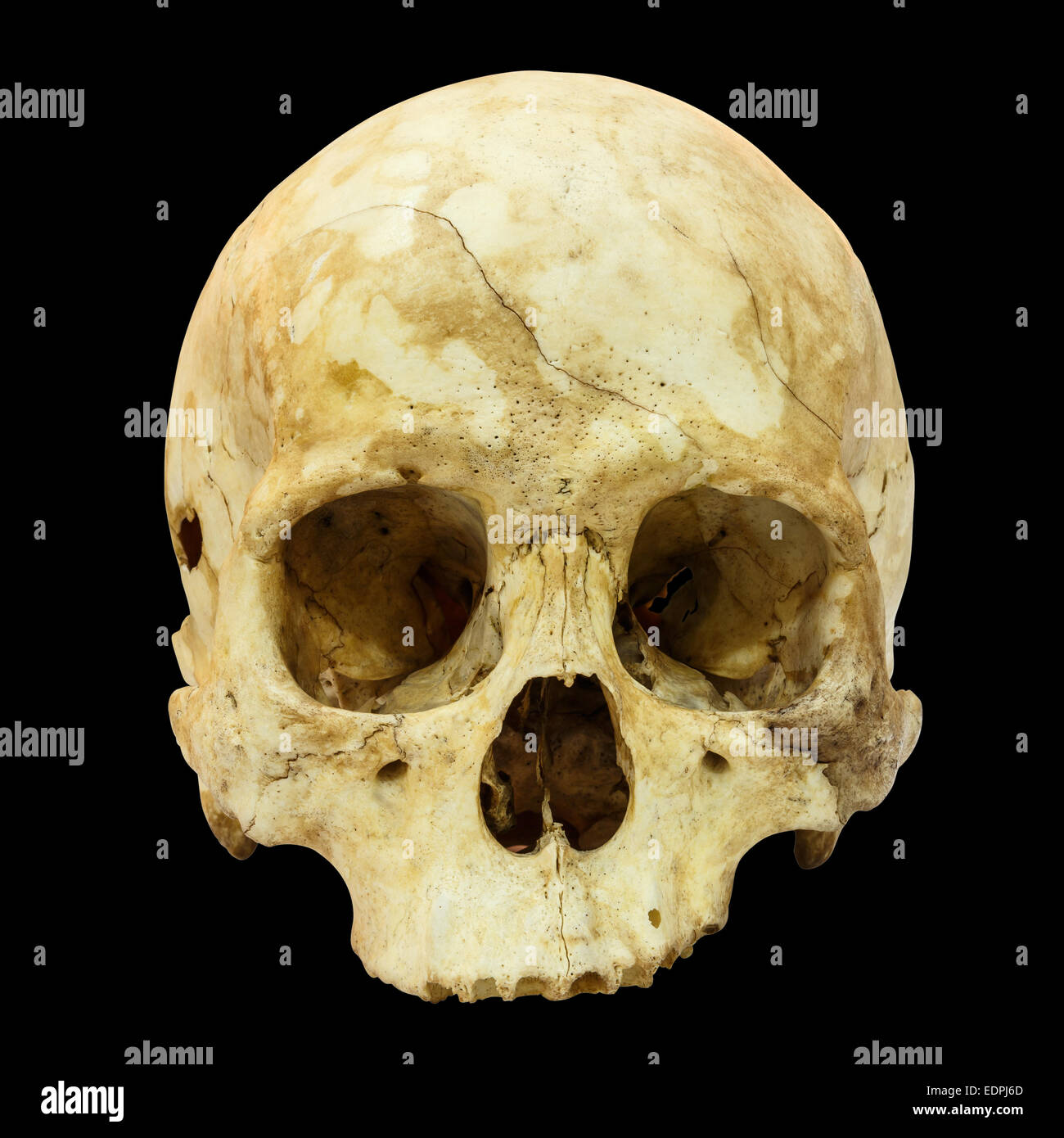 Fracture du crâne humain (Mongoloïdes,Asiatique) sur fond isolé Banque D'Images