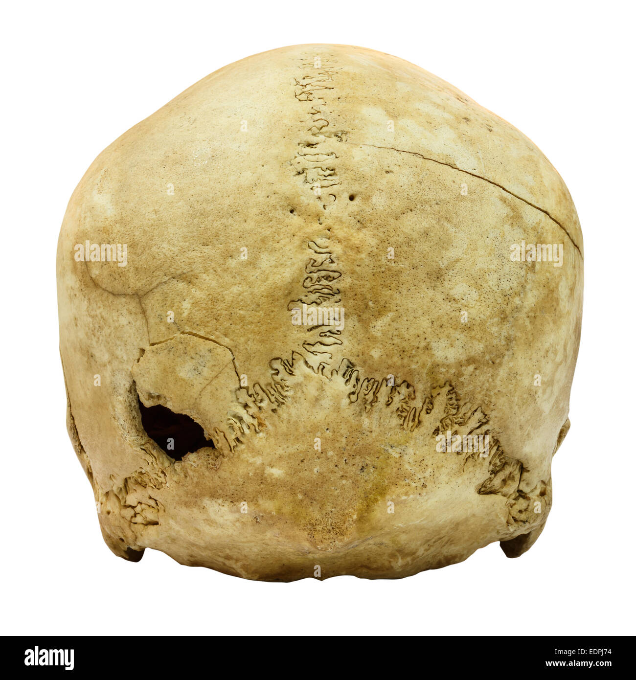 Fracture du crâne humain (arrière) (Mongoloïdes,Asiatique) sur fond isolé Banque D'Images