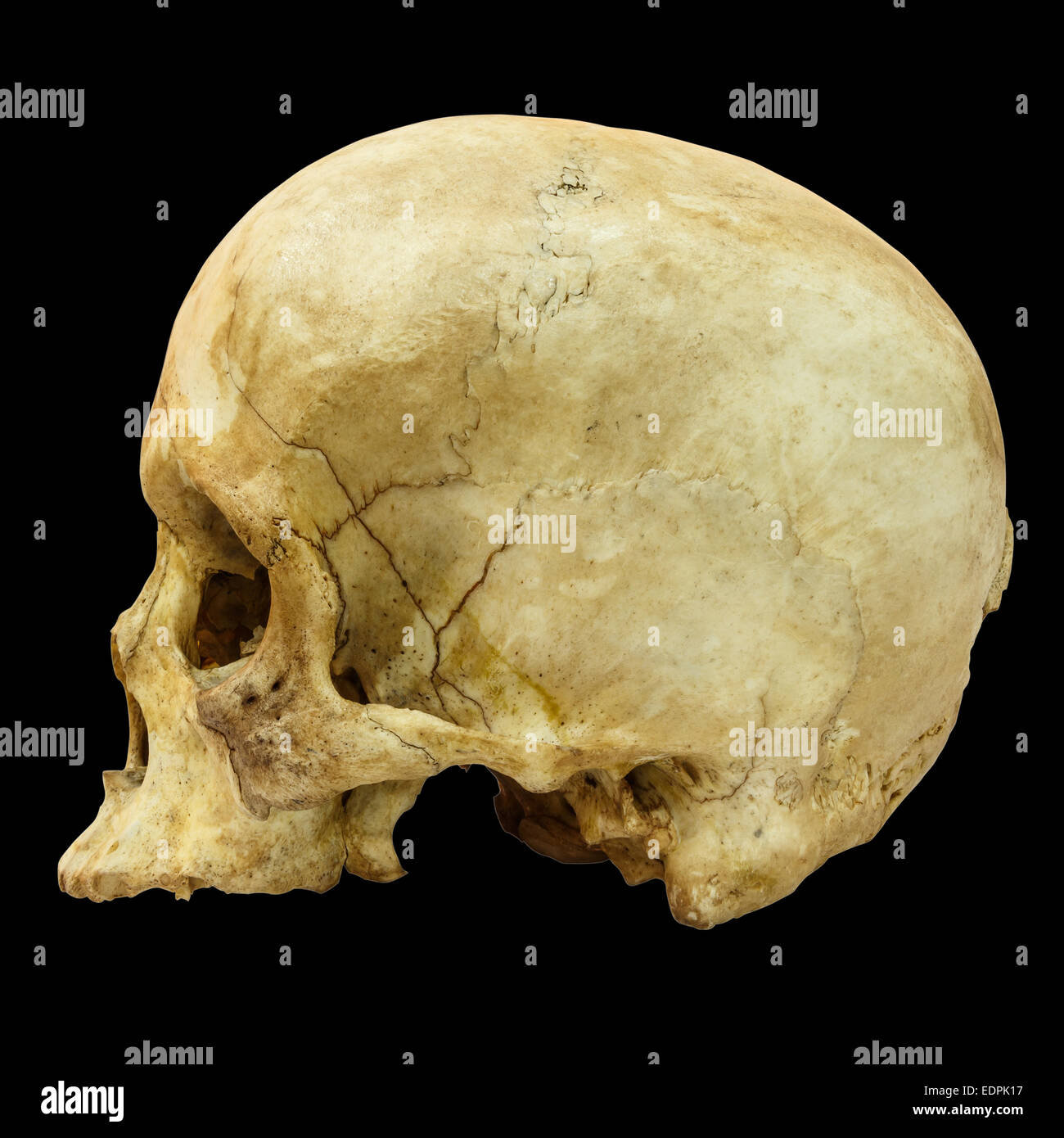 Fracture du crâne humain (côté) (Mongoloïdes,Asiatique) sur fond isolé Banque D'Images