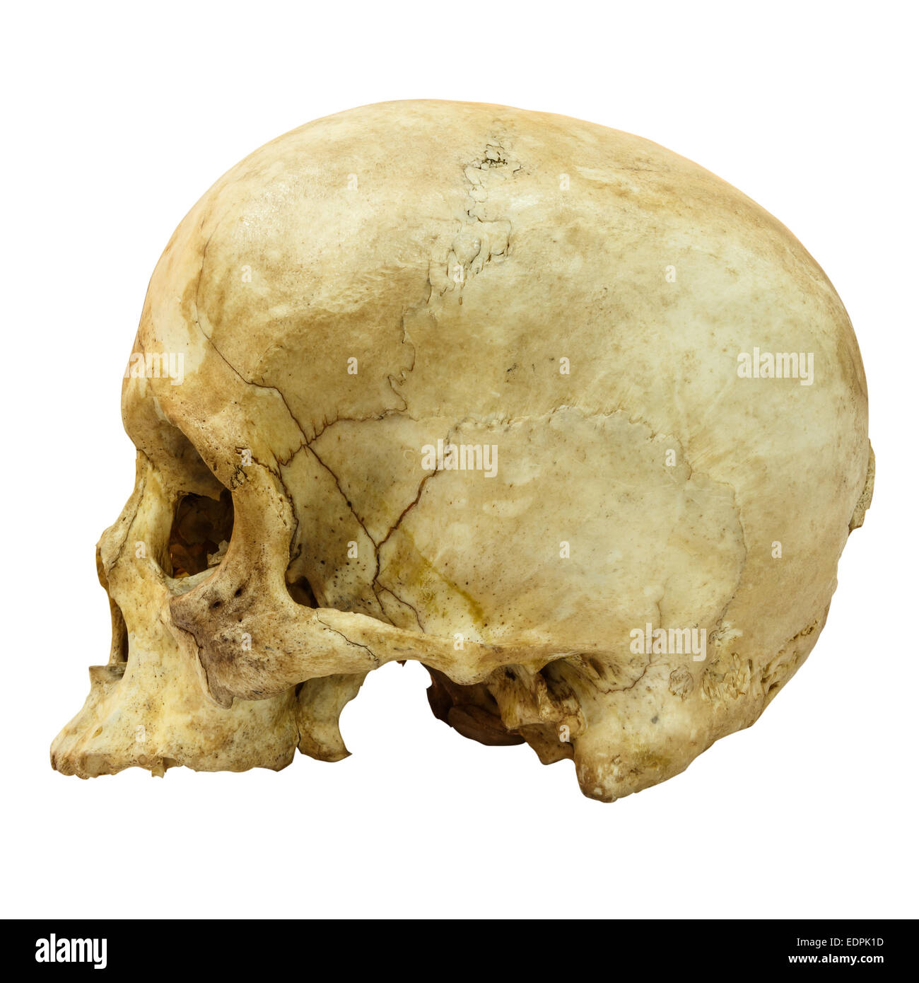 Fracture du crâne humain (côté) (Mongoloïdes,Asiatique) sur fond isolé Banque D'Images