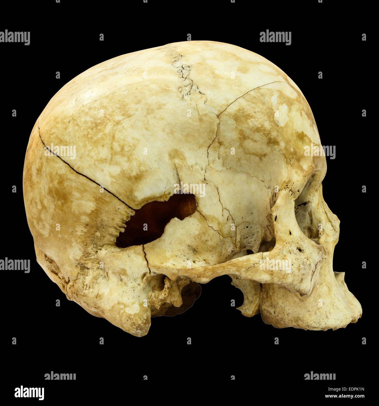 Fracture du crâne humain(côté) (Mongoloïdes,Asiatique) sur fond isolé Banque D'Images