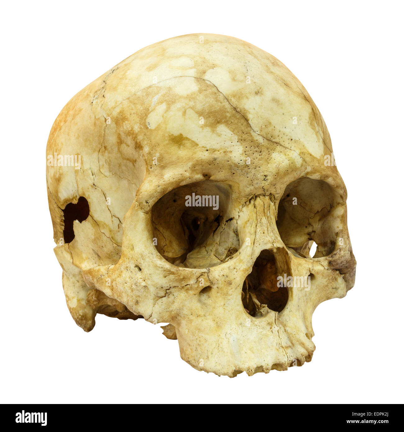 Fracture du crâne humain(côté) (Mongoloïdes,Asiatique) sur fond isolé Banque D'Images