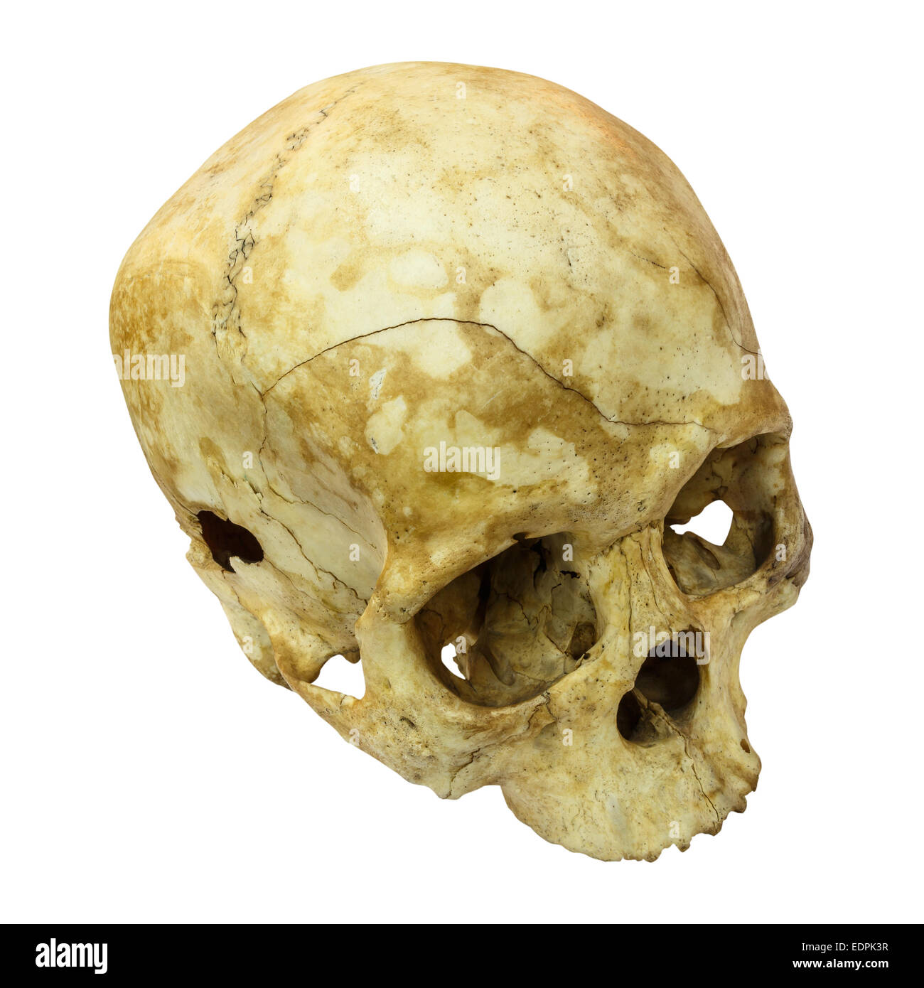 Fracture du crâne humain(côté supérieur,apex)(Mongoloïdes,Asiatique) sur fond isolé Banque D'Images