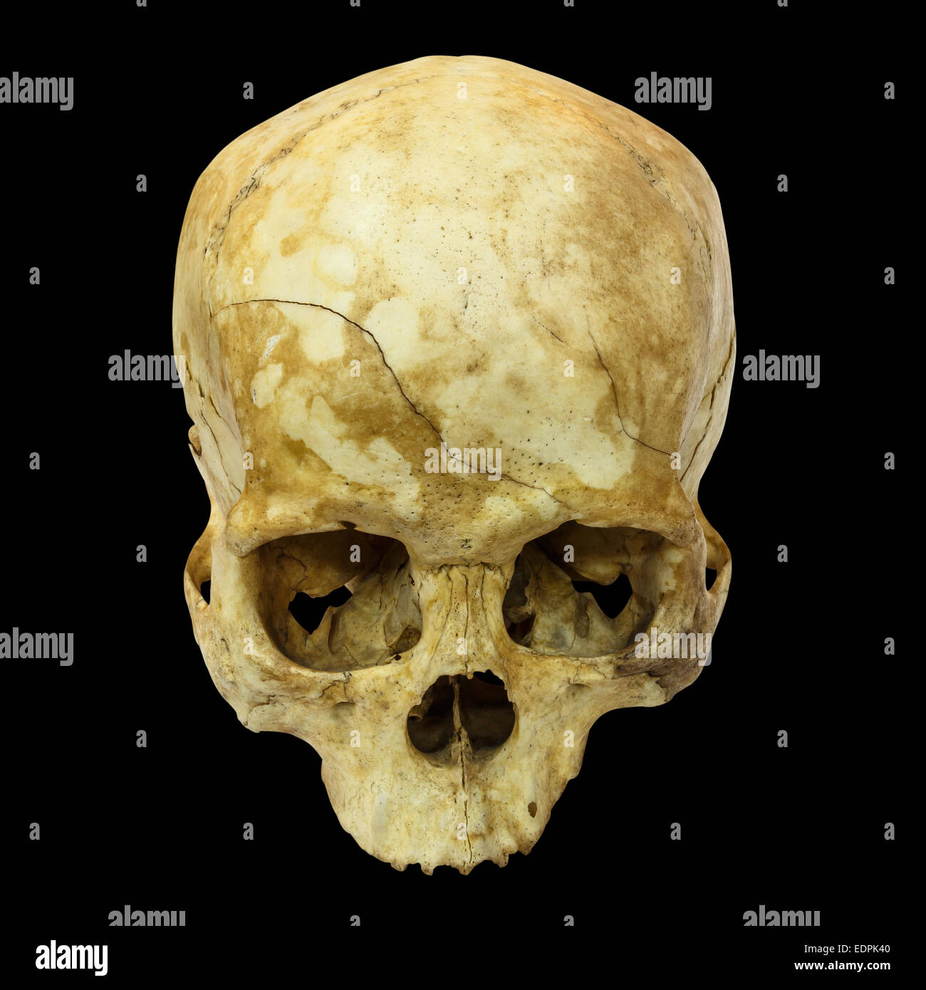 Fracture du crâne humain(côté supérieur,apex)(Mongoloïdes,Asiatique) sur fond isolé Banque D'Images