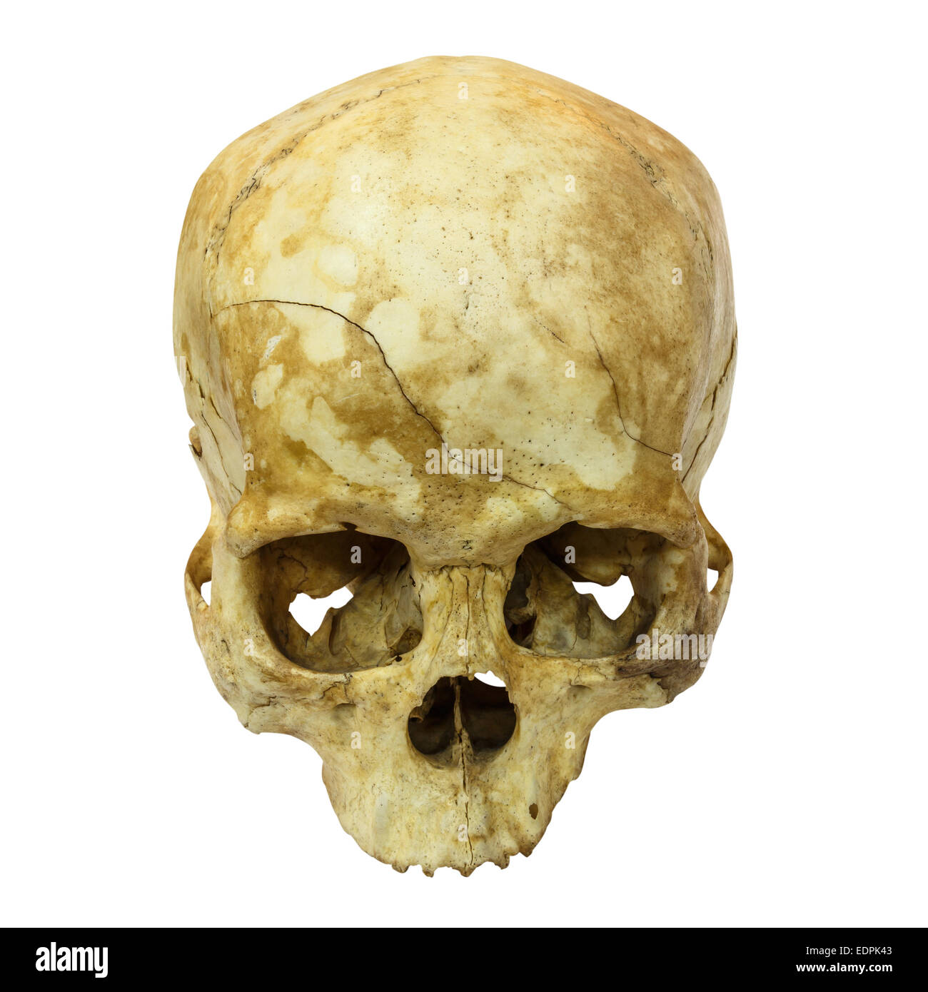 Fracture du crâne humain(côté supérieur,apex)(Mongoloïdes,Asiatique) sur fond isolé Banque D'Images