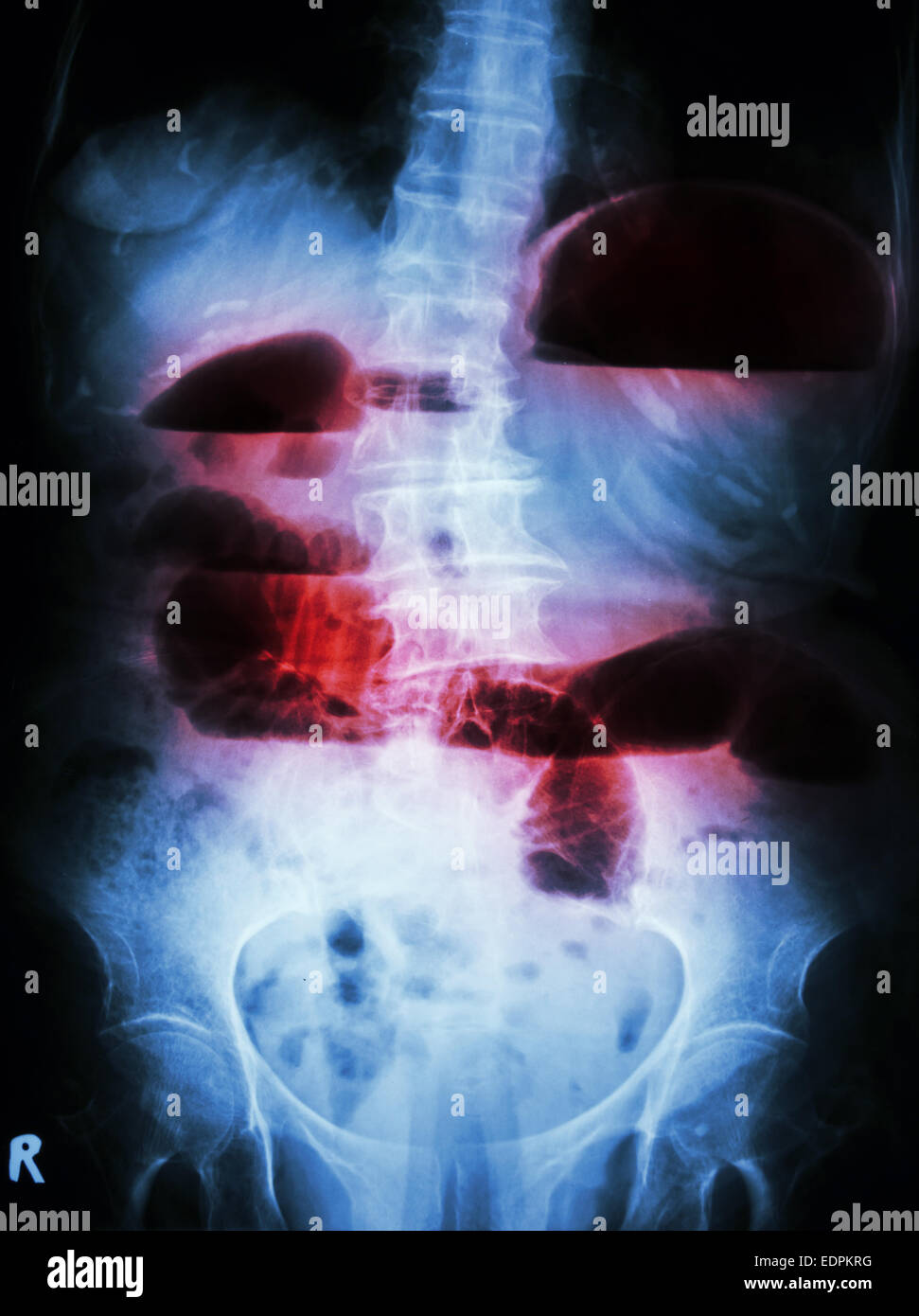 Film X-ray abdomen show debout petit intestin dilaté et de niveau de liquide dans l'intestin grêle occlusion intestinale due à la petite Banque D'Images