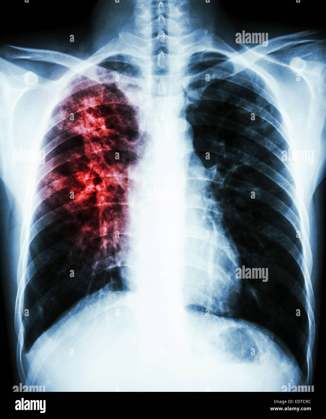 Film radiographie de la PA en position verticale : afficher d'infiltration interstitielle au poumon droit en raison de l'infection à Mycobacterium tuberculosis (Pulmonar Banque D'Images