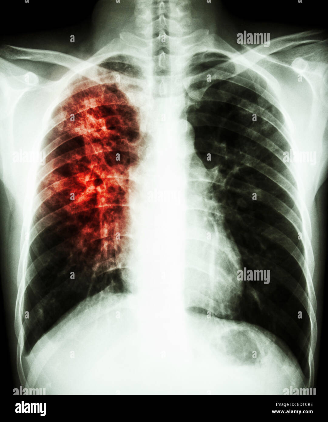 Film radiographie de la PA en position verticale : afficher d'infiltration interstitielle au poumon droit en raison de l'infection à Mycobacterium tuberculosis (Pulmonar Banque D'Images