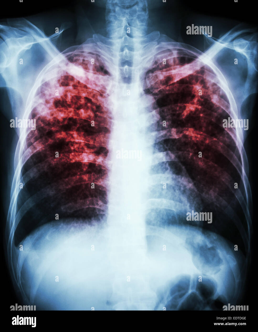 Le film 'La tuberculose pulmonaire La radiographie pulmonaire infiltration interstitielle montrent à la fois en raison de l'infection à Mycobacterium tuberculosis Banque D'Images