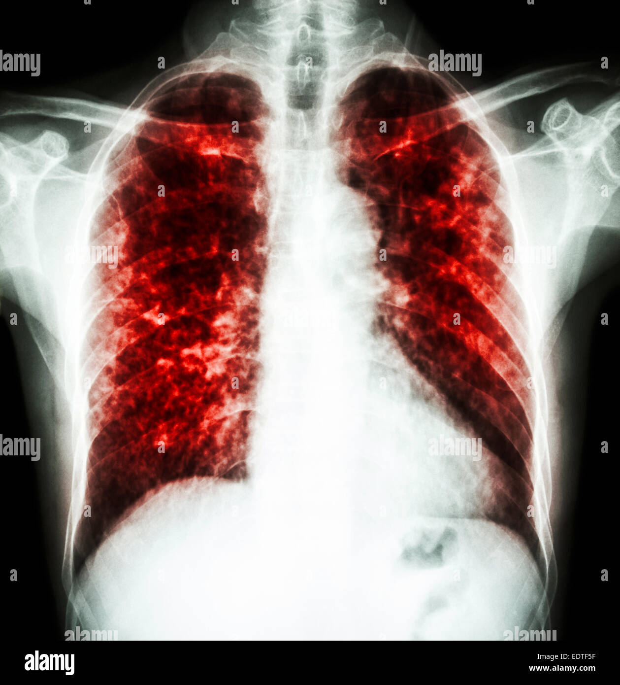 Film radiographie pulmonaire interstitielle pulmonaire montrent tant d'infiltrer en raison de l'infection à Mycobacterium tuberculosis (tuberculose pulmonaire) Banque D'Images