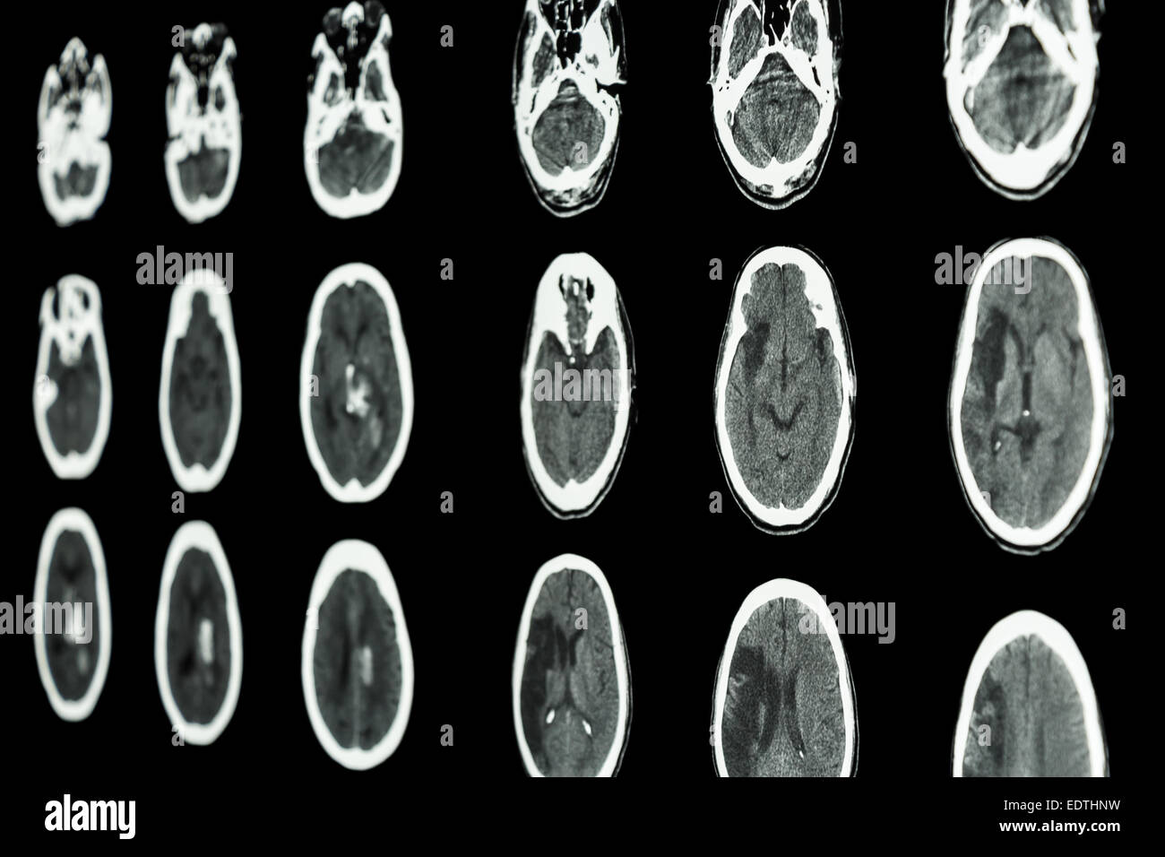 Scanner de film de cerveau indiquent l'accident vasculaire cérébral ischémique et l'accident vasculaire cérébral hémorragique Banque D'Images