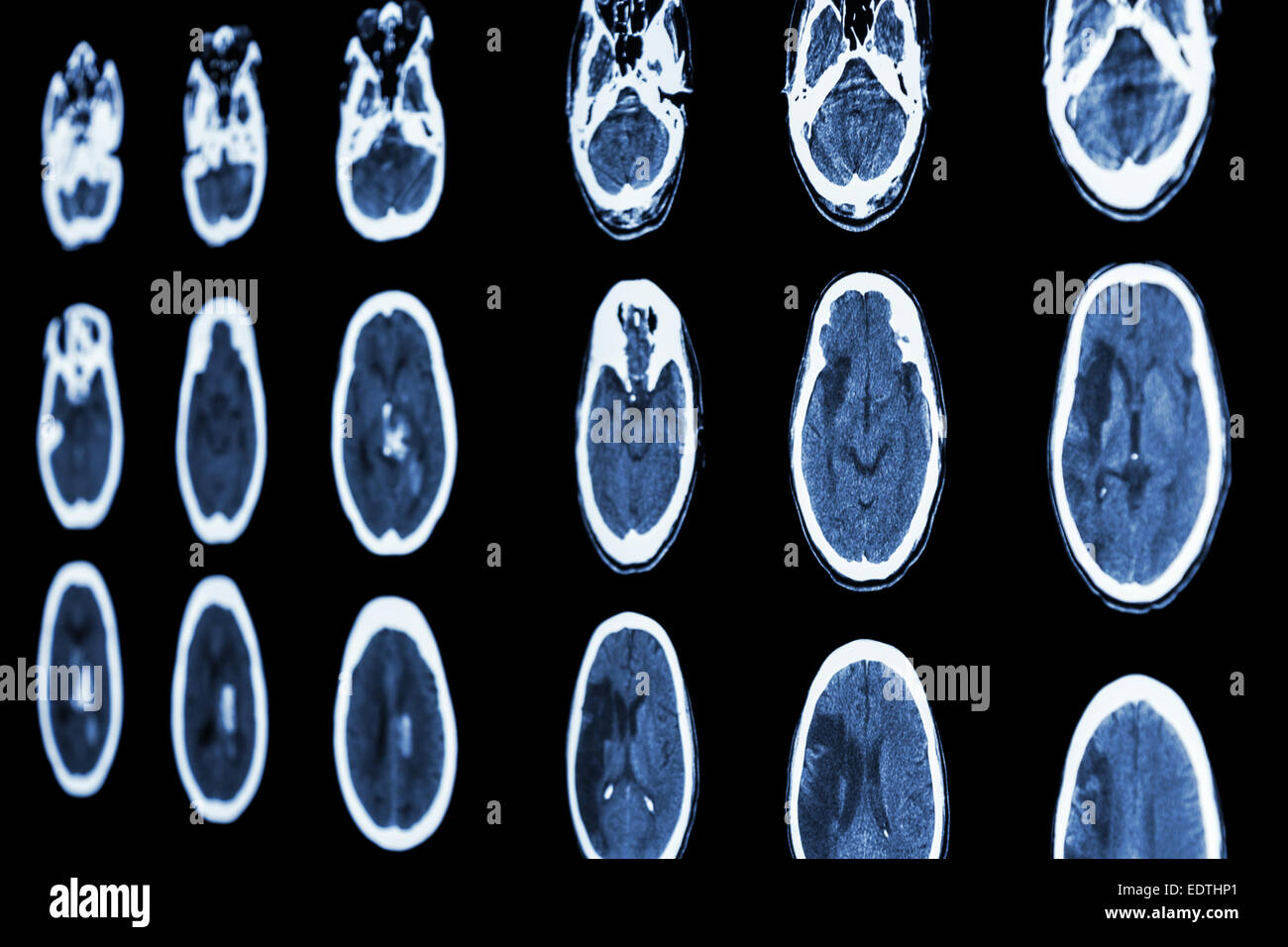 Scanner de film de cerveau indiquent l'accident vasculaire cérébral ischémique et l'accident vasculaire cérébral hémorragique Banque D'Images
