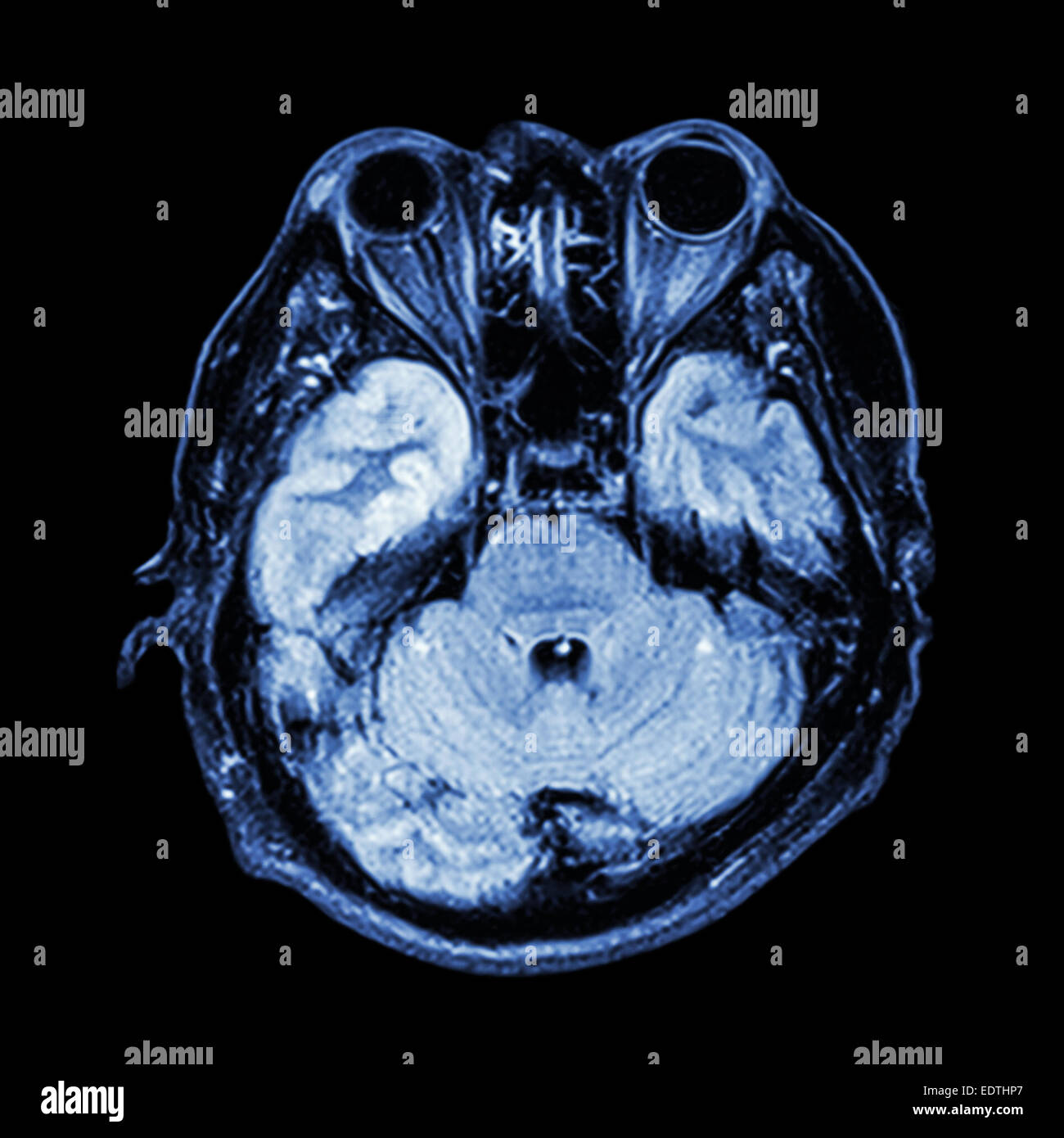 Cerveau IRM : voir Partie inférieure de cerveau(cervelet, lobe temporal du cerveau, tronc cérébral, ethmoïde,oeil,sinus structure de crâne) Banque D'Images