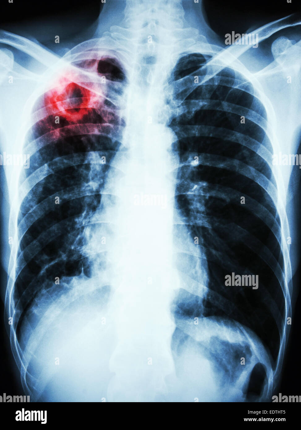 Film radiographie de la montrer à la cavité pulmonaire supérieure droite en raison de l'infection à Mycobacterium tuberculosis (tuberculose pulmonaire) Banque D'Images
