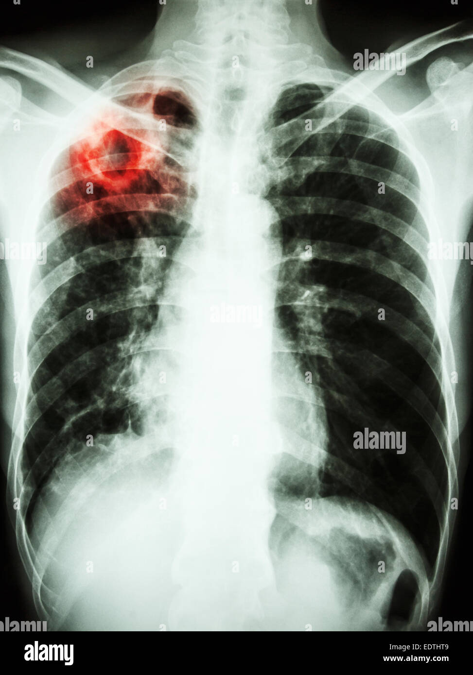 Film radiographie de la montrer à la cavité pulmonaire supérieure droite en raison de l'infection à Mycobacterium tuberculosis (tuberculose pulmonaire) Banque D'Images