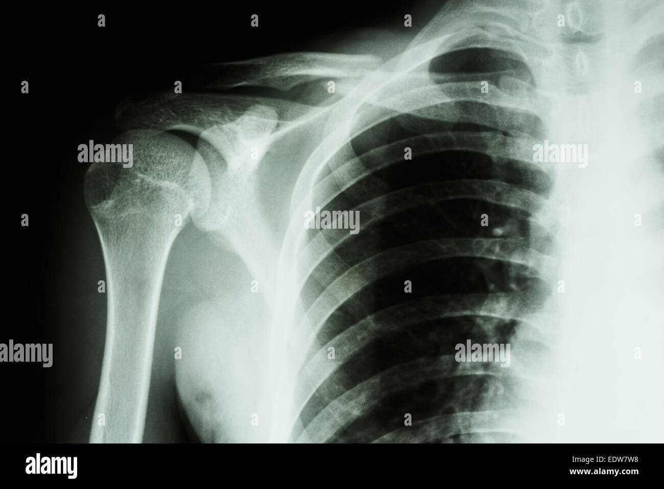 Film X-ray show moyen fracture clavicule droite Banque D'Images